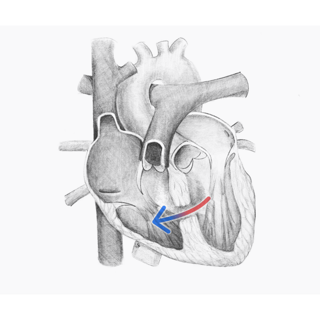 Types of Abnormal Heart Sounds