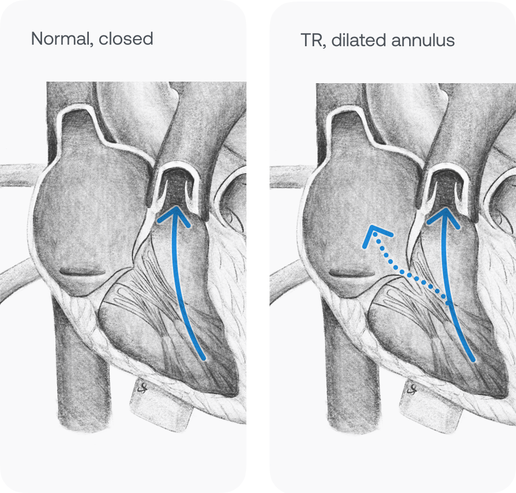 Pencil drawing of hearts with and without Tricuspid Regurgitation 